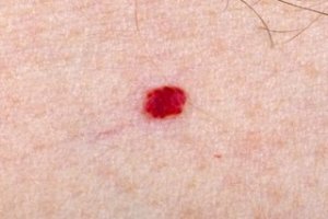 Cherry Angioma- Blood Spots