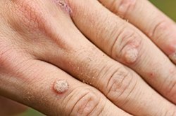 Warts – (hands and feet) and Verrucae (Plantar Warts)